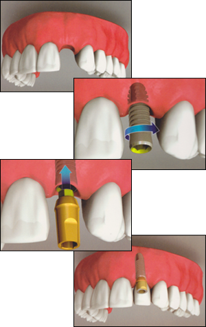 Dixie Dental Implants in Mississauga, Cosmetic Dentist