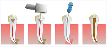 Root canal therapy in Mississauga